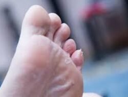 Cara Mengatasi dan Mencegah Kapalan di Kaki Akibat Salah Pilih Sepatu