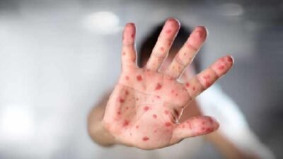 "Sedikitnya 38 anak meninggal dunia akibat wabah campak di Bangladesh. Pemerintah turunkan usia vaksinasi jadi 6 bulan untuk tekan angka kematian. "