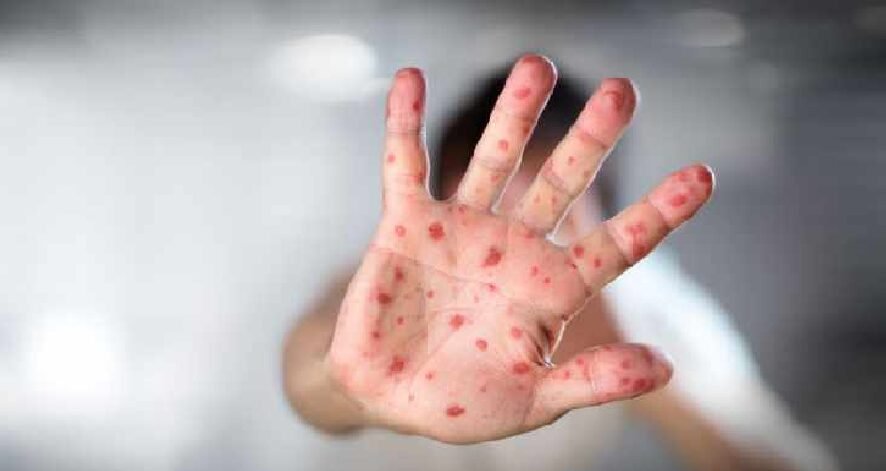 "Sedikitnya 38 anak meninggal dunia akibat wabah campak di Bangladesh. Pemerintah turunkan usia vaksinasi jadi 6 bulan untuk tekan angka kematian. "